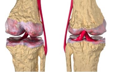 Venas varicosas del desarrollo de gonartrosis