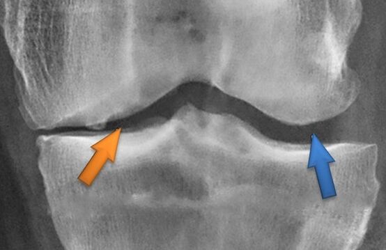 Kines Butapy para la artrosis