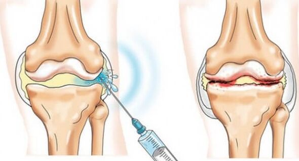 Medidas médicas para la artrosis