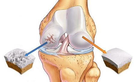 ¿Qué es la artrosis de la articulación de la rodilla